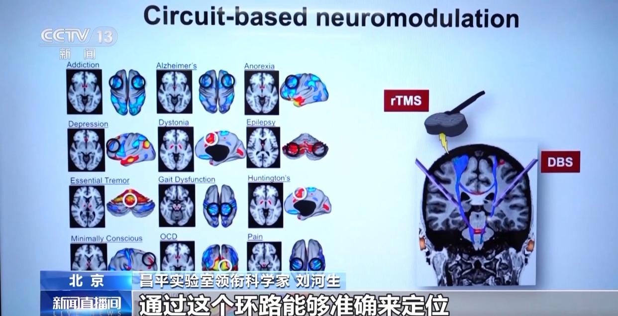 帕金森病治疗有新突破！中国科研团队发现核心致病环路