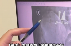 
江苏省中医院黄牛号贩子票贩子代网上预约代挂号电话男孩每天坚持猛跑1小时把骨头跑断了 医生：近期已接诊三四例
