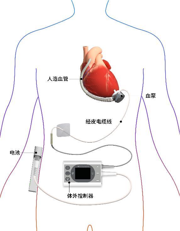 
首都医科大学附属口腔医院黄牛号贩子票贩子代网上预约代挂号电话同心医疗BrioVAD欧洲临床率先在荷兰获批，国际化进程再提速