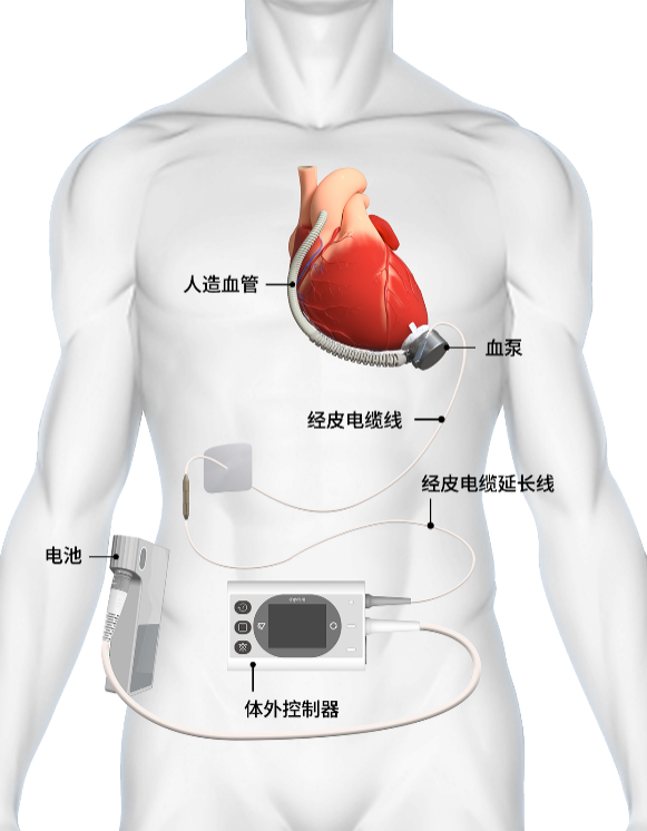 
北大口腔医院黄牛号贩子票贩子代网上预约代挂号电话BRIOLIFE欧洲临床启动 同心医疗成国内唯一实现中美欧三地临床布局的人工心脏企业